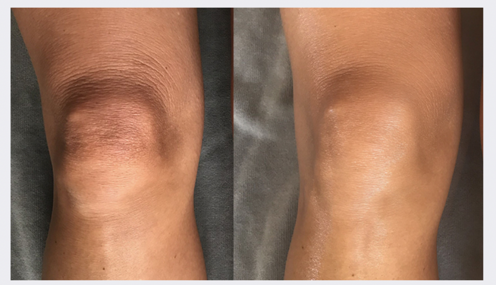 Profhilo Body pred/po