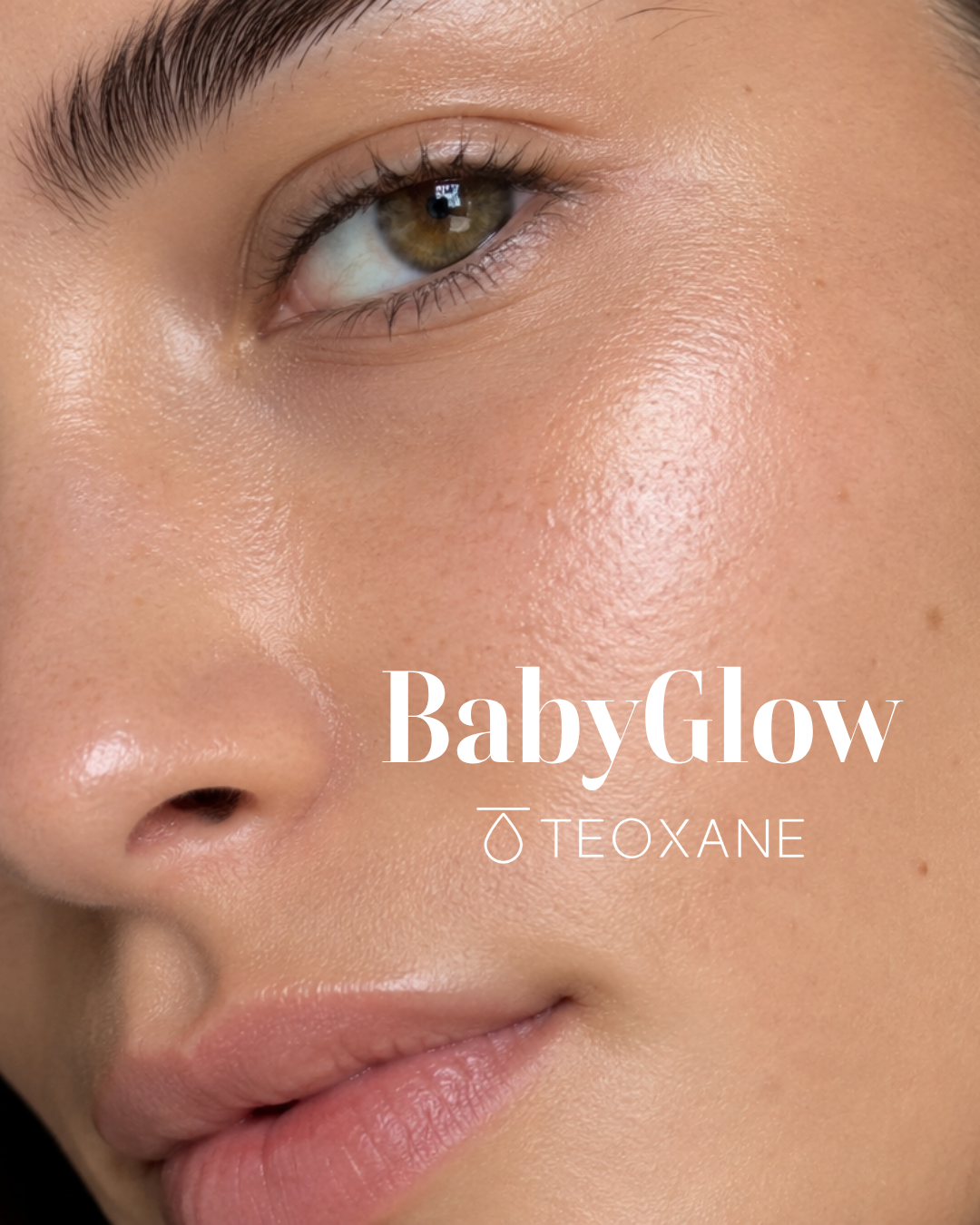 babyglow teoxane